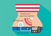 Diabetes care AIDed by new digital technologies