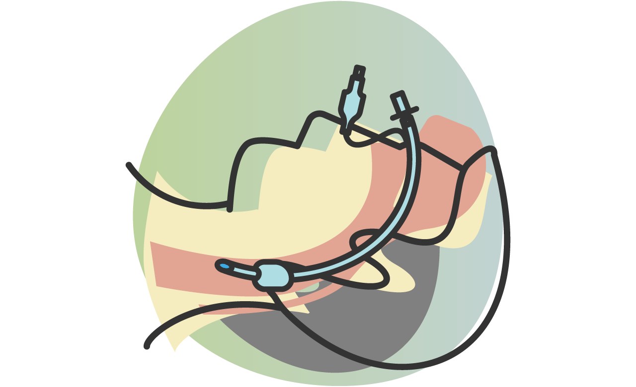 Vector illustration of an intubated head in profile 
