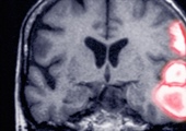 Do statins have an effect on hemorrhagic stroke? New study raises the question, again