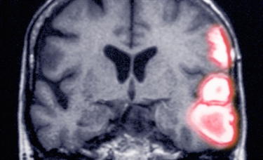 Do statins have an effect on hemorrhagic stroke? New study raises the question, again