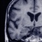 Do statins have an effect on hemorrhagic stroke? New study raises the question, again