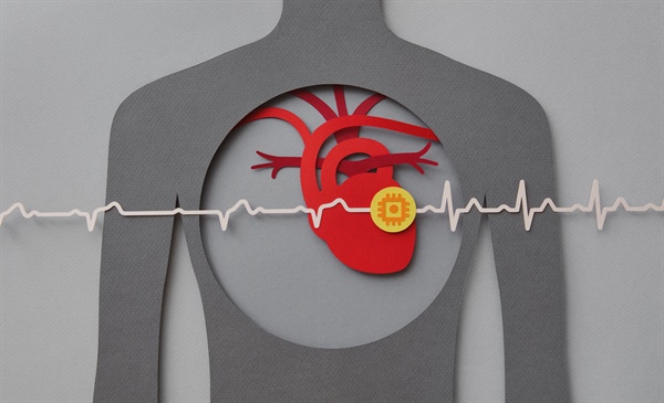 Study provides insights on ideal DOAC timing for patients with AFib post stroke