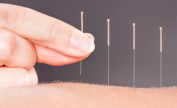 Acupuncture