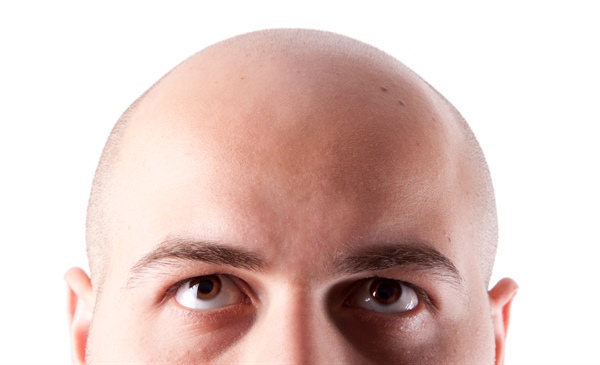 Hair loss