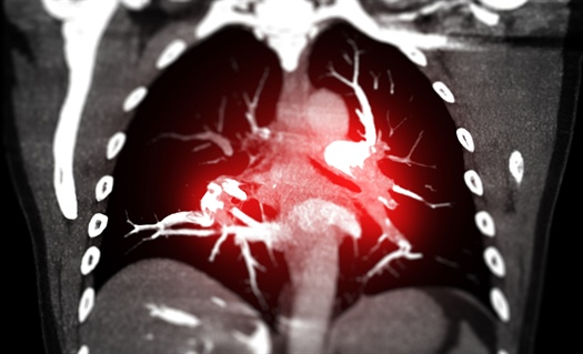 Dosing error with sildenafil oral suspension