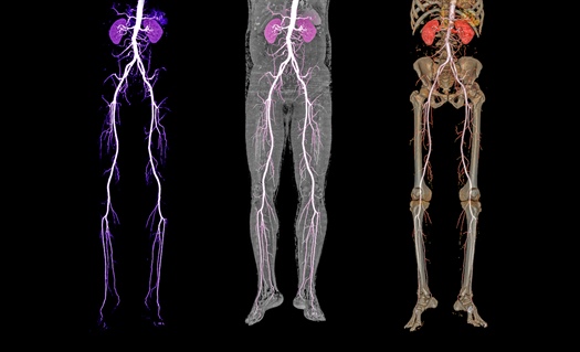 AHA: More awareness needed for lower extremity PAD