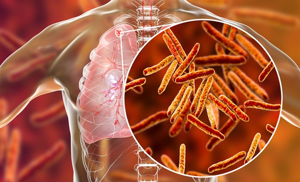 Treating latent tuberculosis