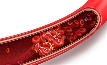 Patients with COVID-19 may experience abnormal clotting