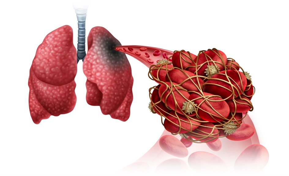 New ASH guidelines on managing VTE recommend home treatment, DOACs