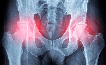 Gabapentinoids may raise risk for hip fracture