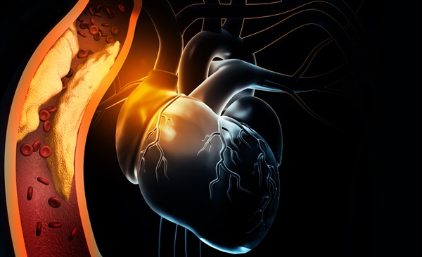 ApoB could be best predictor of future MI risk