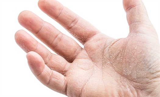 Scaly dermatoses: What’s that itch?
