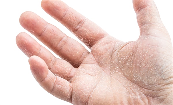 Scaly dermatoses: What’s that itch?