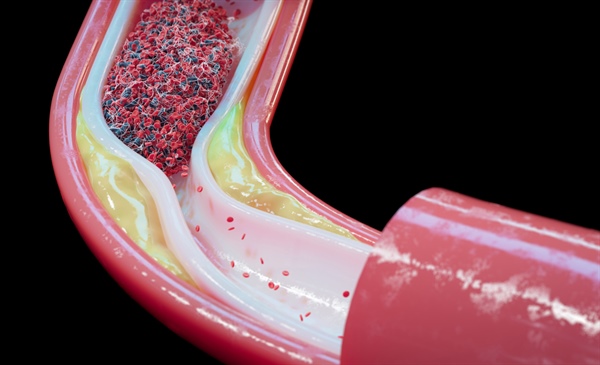 AHA, ACC release new guidelines on acute coronary syndrome