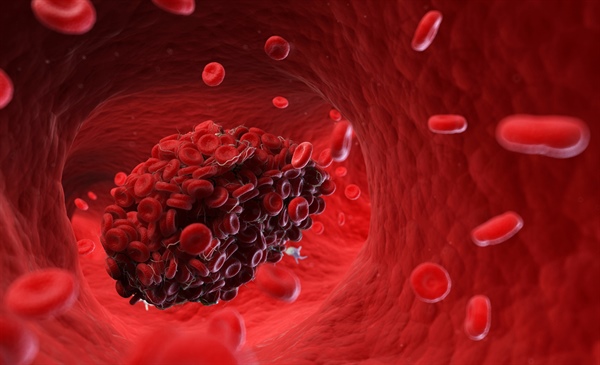 Study findings suggest DOACs are favorable treatment option for CVT