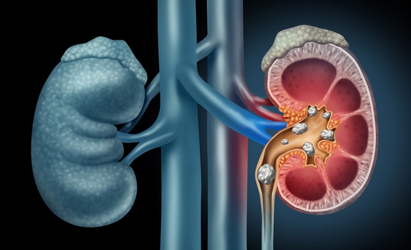 Anticonvulsants topiramate and zonisamide raise risk for kidney stones, study finds