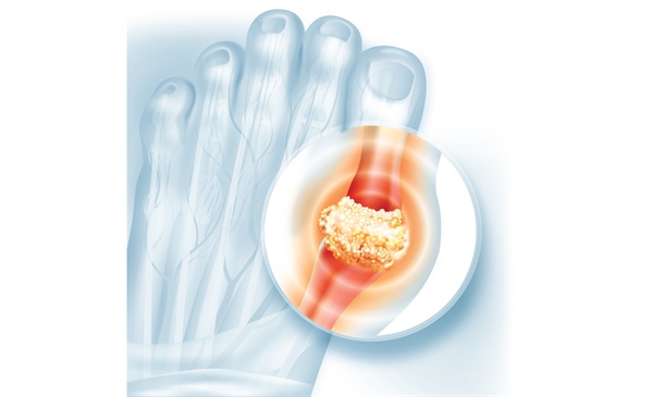 NSAIDs could pose CVD risk to patients with gout
