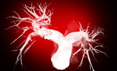 Apixaban shows lower bleeding risk than rivaroxaban in acute VTE treatment